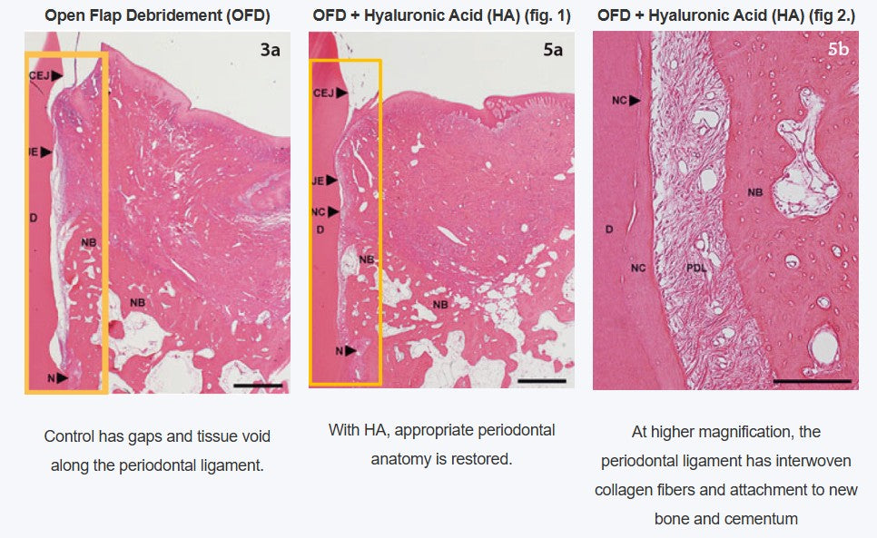 PerioVive | Hyaluronic acid gel